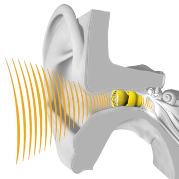 Extended Wear Hearing Aid - Lyric - Phonak